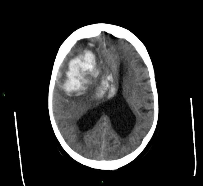 File:Cerebral amyloid angiopathy-associated lobar intracerebral hemorrhage (Radiopaedia 58560-65723 Axial non-contrast 22).jpg