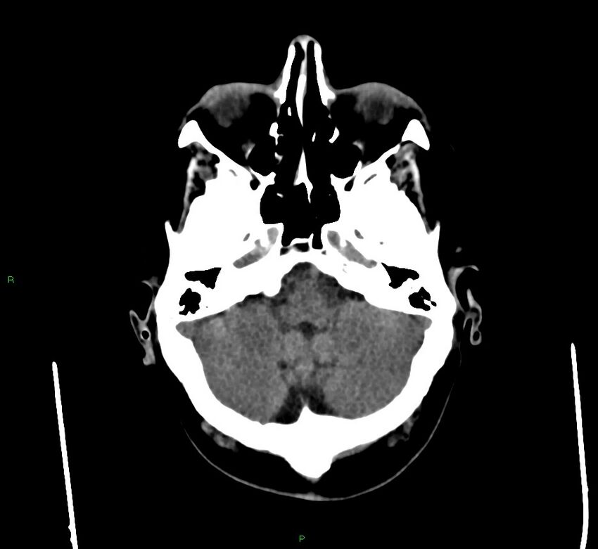 Cerebral amyloid angiopathy-associated lobar intracerebral hemorrhage (Radiopaedia 58560-65723 Axial non-contrast 42).jpg