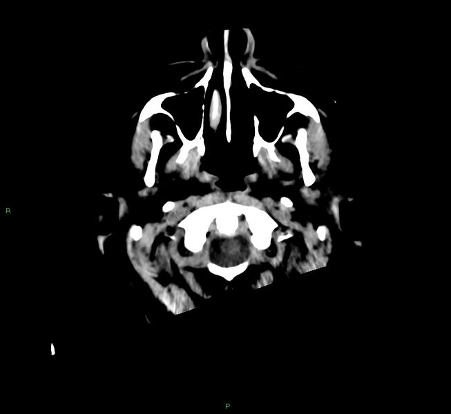 File:Cerebral amyloid angiopathy-associated lobar intracerebral hemorrhage (Radiopaedia 58560-65723 Axial non-contrast 51).jpg