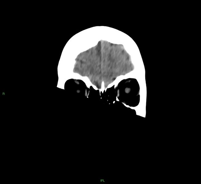 File:Cerebral amyloid angiopathy-associated lobar intracerebral hemorrhage (Radiopaedia 58754-65975 Coronal non-contrast 52).jpg