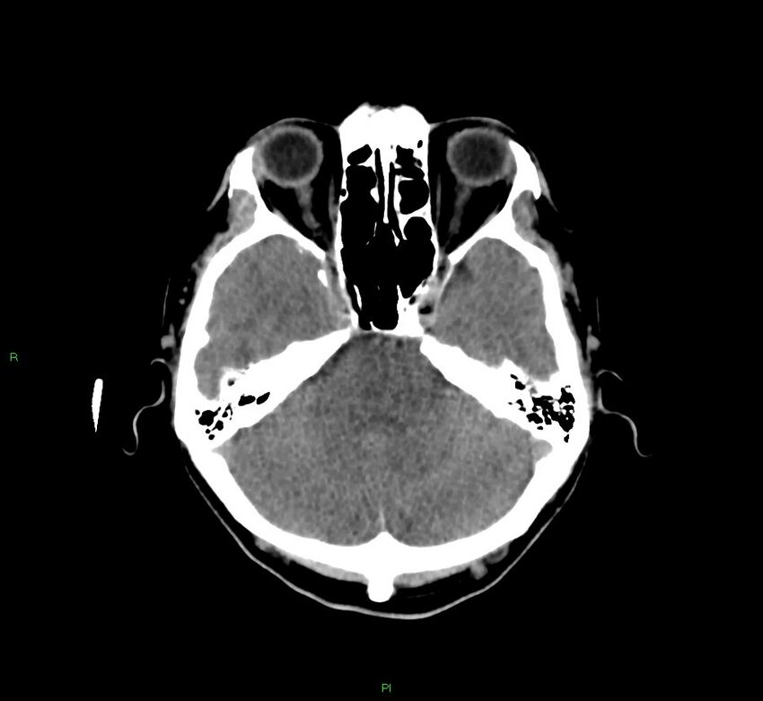 Cerebral amyloid angiopathy-associated lobar intracerebral hemorrhage (Radiopaedia 58756-65977 Axial non-contrast 38).jpg