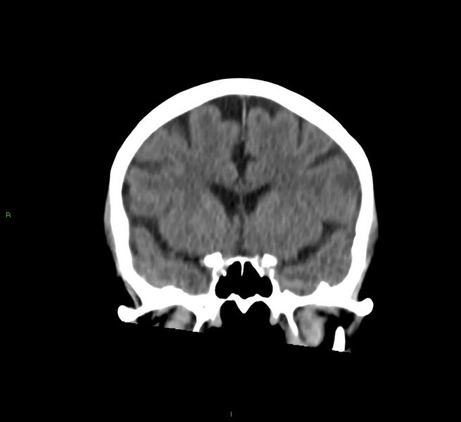 File:Cerebral amyloid angiopathy-associated lobar intracerebral hemorrhage (Radiopaedia 58757-65978 Coronal non-contrast 44).jpg