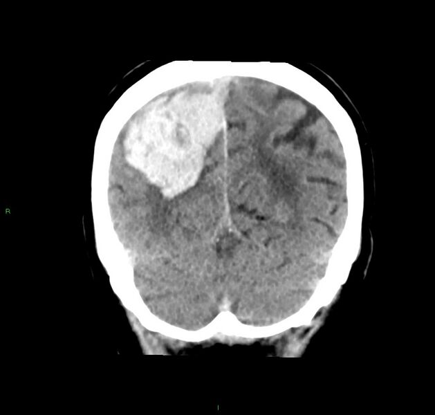 File:Cerebral amyloid angiopathy-associated lobar intracerebral hemorrhage (Radiopaedia 59356-66716 Coronal non-contrast 18).jpg
