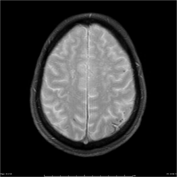 File:Cerebral amyloid angiopathy (Radiopaedia 4561-6683 Axial Gradient Echo 7).jpg