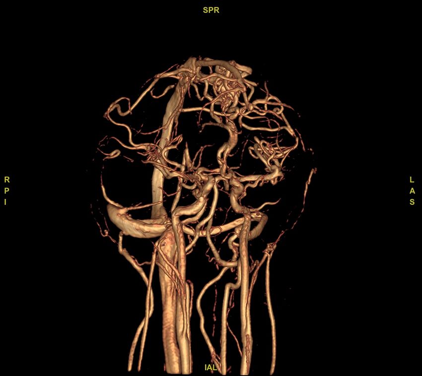 Cerebral arteriovenous malformation (Radiopaedia 61964-70029 VRT 37).jpg