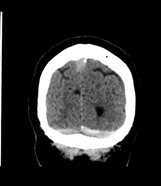 File:Cerebral dural venous sinus thrombosis (Radiopaedia 86514-102575 Coronal non-contrast 48).jpg