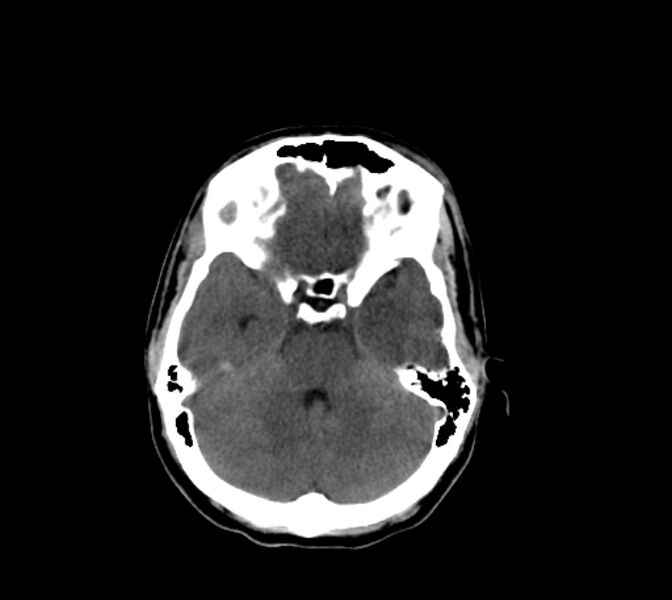 File:Cerebral fat embolism (Radiopaedia 37510-39362 Axial non-contrast 12).jpg