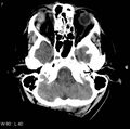 Cerebral hemorrhagic contusion with subdural and subarachnoid hemorrhage (Radiopaedia 10680-11146 Axial non-contrast 4).jpg