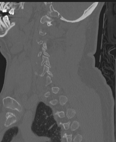 File:Cerebral hemorrhagic contusions and cervical spine fractures (Radiopaedia 32865-33841 Sagittal bone window 69).jpg