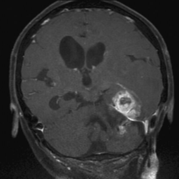 File:Cerebral radiation necrosis (Radiopaedia 7248-8188 E 1).jpg