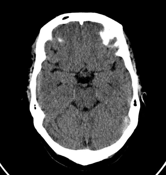 File:Cerebral venous thrombosis - CT only (Radiopaedia 41031-43778 Axial non-contrast 57).jpg