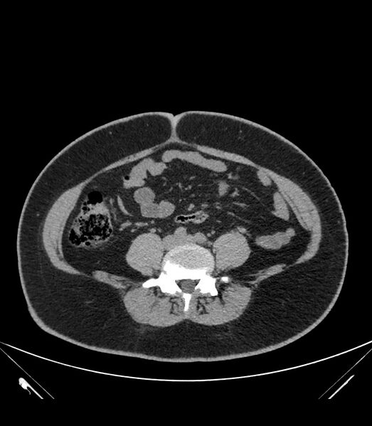 File:Cervical aortic arch with coarctation and aneurysms (Radiopaedia 44035-47552 Axial non-contrast 72).jpg