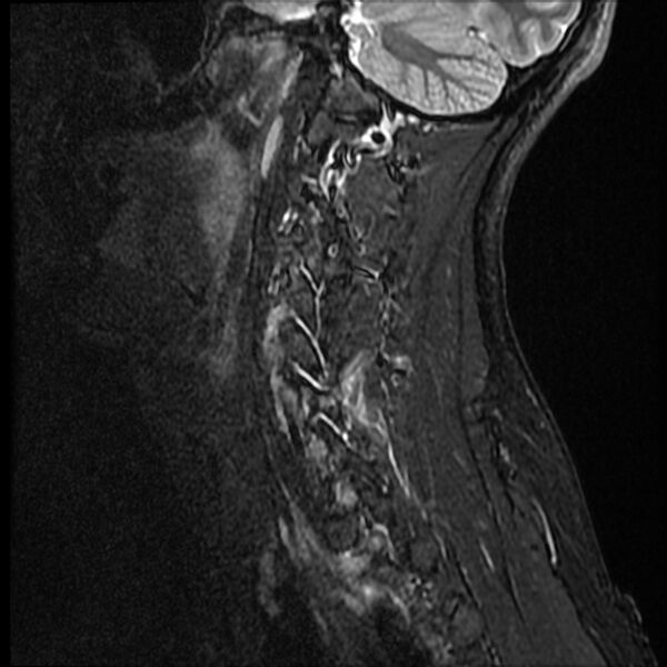 File:Cervical facet fracture and anterior discoligamentous injury (Radiopaedia 32139-33084 Sagittal STIR 1).jpg