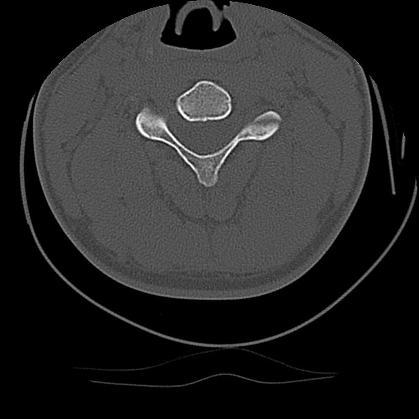 Cervical flexion teardrop fracture with cord hemorrhage (Radiopaedia 32497-33454 Axial bone window 36).jpg