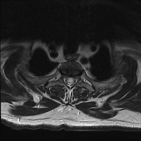 File:Cervical tumor-like myelopathy due to Type V dAVF (Radiopaedia 82461-96604 Axial T2 36).jpg