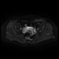 Cesarian section scar endometriosis (Radiopaedia 66520-75799 Axial DWI 37).jpg