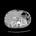Chance fracture with duodenal and pancreatic lacerations (Radiopaedia 43477-46864 A 1).jpg