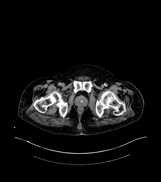 File:Cholangiocarcinoma with cerebral metastases (Radiopaedia 83519-98629 Axial non-contrast 126).jpg