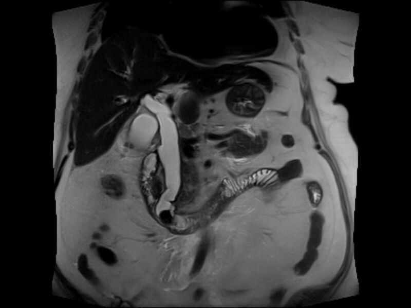 File:Choledocholithiasis causing intrahepatic biliary duct dilation (Radiopaedia 39908-42369 Coronal T2 10).jpg