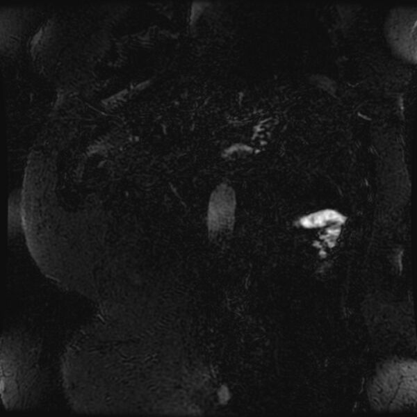 File:Choledocholithiasis on CT and MRI (Radiopaedia 24825-25088 Coronal T2 108).jpg