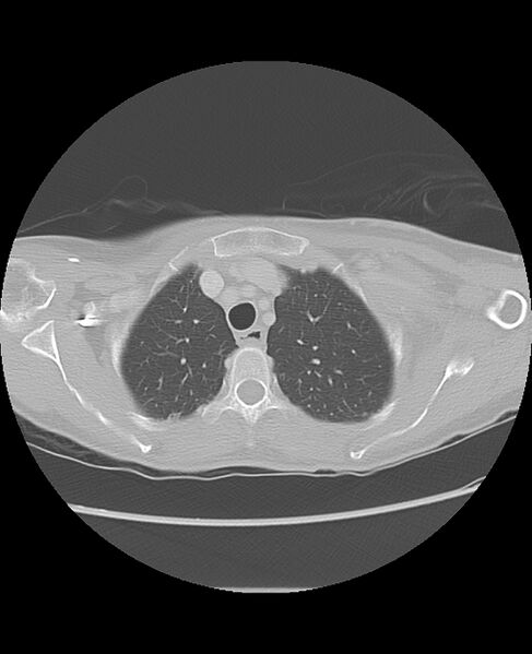 File:Chondrosarcoma (Radiopaedia 79427-92532 Axial lung window 11).jpg
