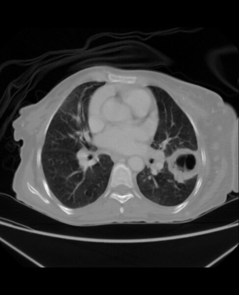 File:Chondrosarcoma (Radiopaedia 79427-92535 Axial lung window 28).jpg