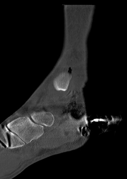 File:Chopart fracture (Radiopaedia 35347-36861 Sagittal bone window 29).jpg