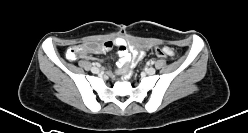 File:Choriocarcinoma liver metastases (Radiopaedia 74768-85766 A 158).jpg