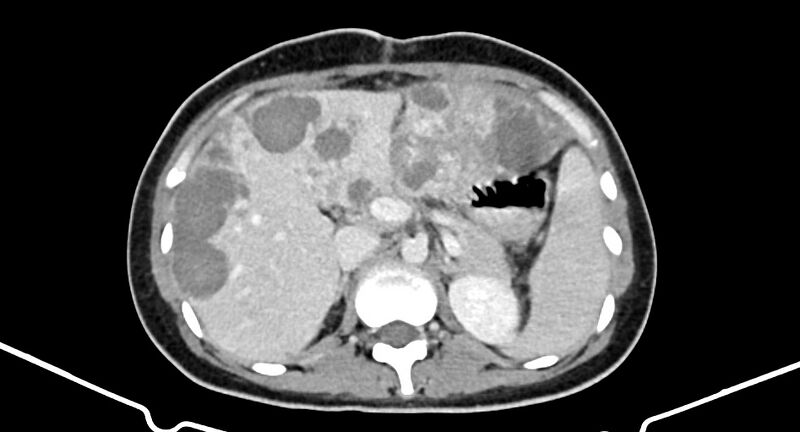 File:Choriocarcinoma liver metastases (Radiopaedia 74768-85766 A 74).jpg