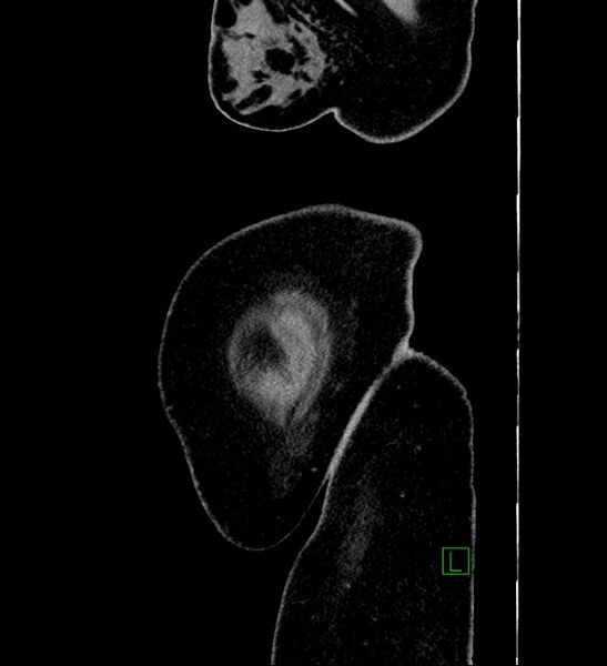 File:Chromophobe renal cell carcinoma (Radiopaedia 84239-99519 G 2).jpg