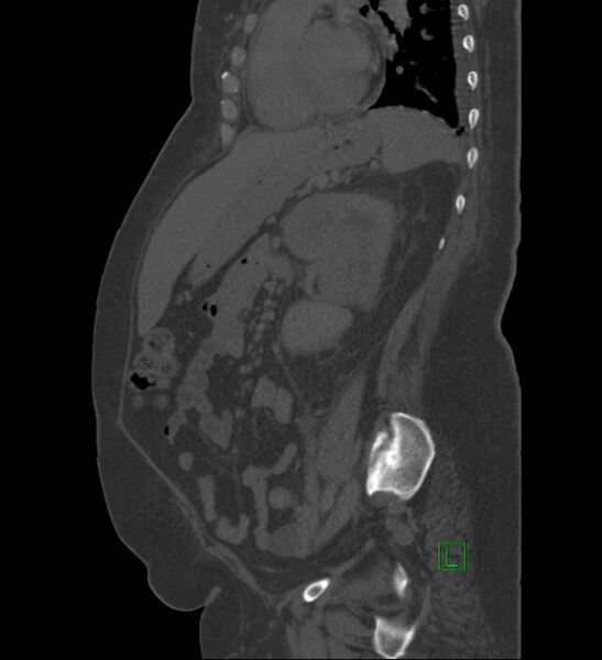 File:Chromophobe renal cell carcinoma (Radiopaedia 84239-99519 Sagittal bone window 38).jpg