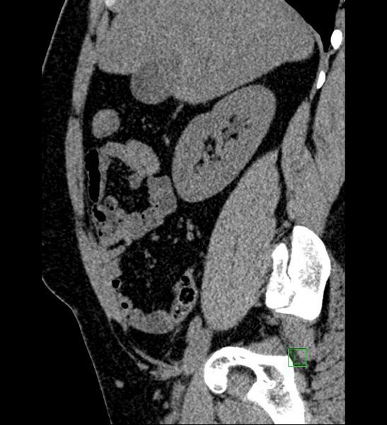 File:Chromophobe renal cell carcinoma (Radiopaedia 84286-99573 C 127).jpg
