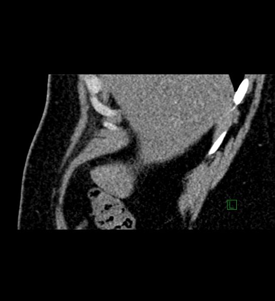 File:Chromophobe renal cell carcinoma (Radiopaedia 84286-99573 F 159).jpg