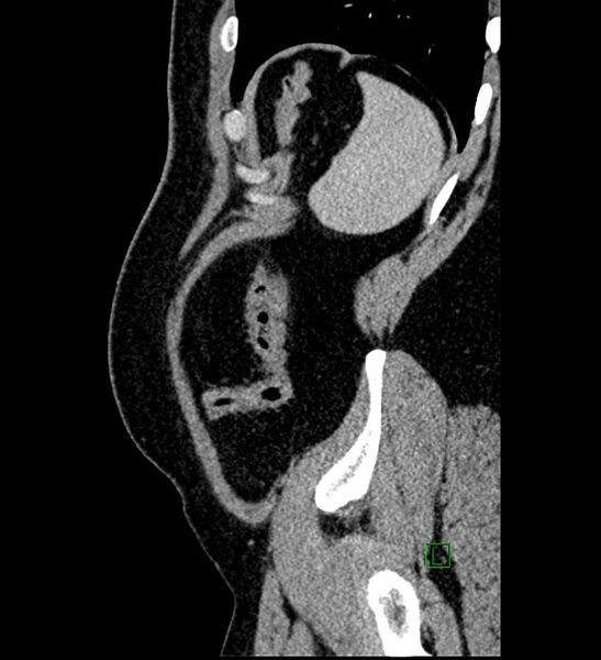 File:Chromophobe renal cell carcinoma (Radiopaedia 84286-99573 I 20).jpg