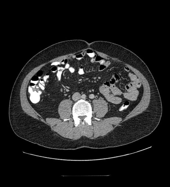 File:Chromophobe renal cell carcinoma (Radiopaedia 84337-99644 C 77).jpg