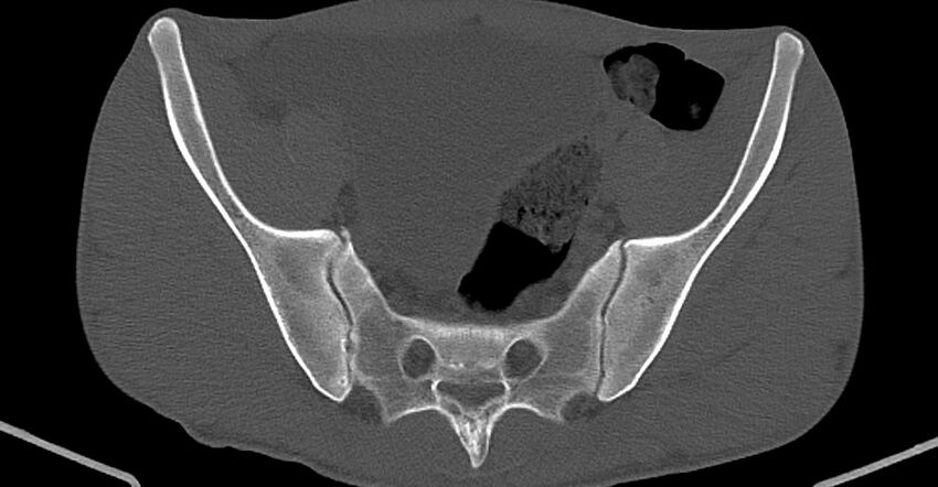 Chronic osteomyelitis (with sequestrum) (Radiopaedia 74813-85822 Axial non-contrast 13).jpg