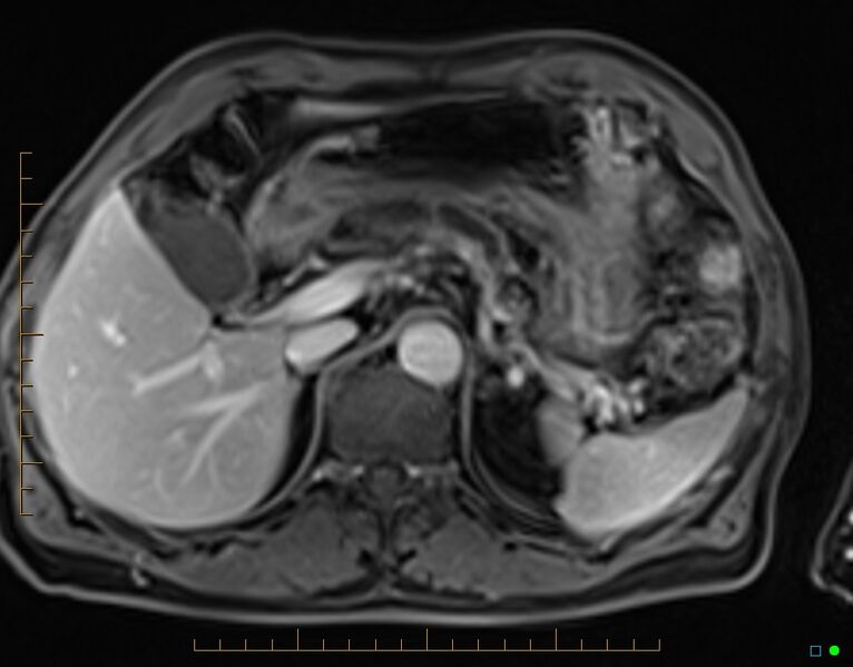 File:Chronic pancreatitis (Radiopaedia 17014-16716 Axial T1 C+ fat sat 20).jpg