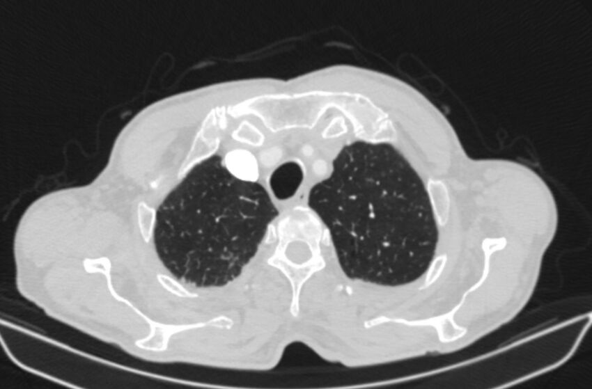 Chronic pulmonary embolism (Radiopaedia 91241-108843 Axial lung window 12).jpg