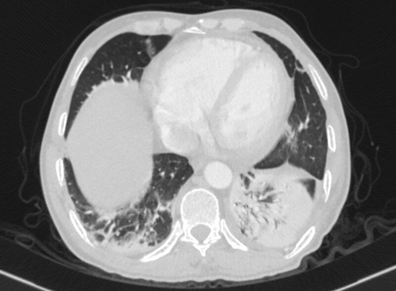 File:Chronic pulmonary embolism with bubbly consolidation (Radiopaedia 91248-108850 Axial lung window 120).jpg