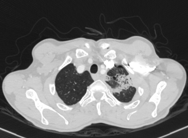 File:Chronic pulmonary embolism with bubbly consolidation (Radiopaedia 91248-108850 Axial lung window 15).jpg