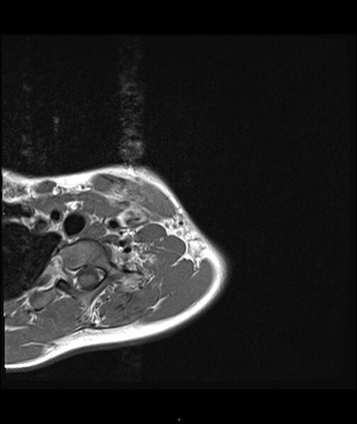File:Chronic reactive multifocal osteomyelitis (CRMO) - clavicle (Radiopaedia 56406-63071 Axial T1 3).jpg