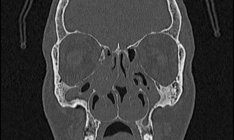 File:Chronic rhinosinusitis (Radiopaedia 65079-74075 Coronal bone window 32).jpg