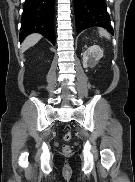 File:Clear cell renal cell carcinoma (Radiopaedia 61449-69393 F 41).jpg