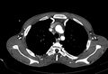Coarctation of aorta with aortic valve stenosis (Radiopaedia 70463-80574 A 26).jpg