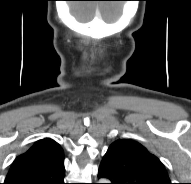File:Colloid cyst of thyroid (Radiopaedia 22897-22923 Coronal C+ delayed 58).jpg