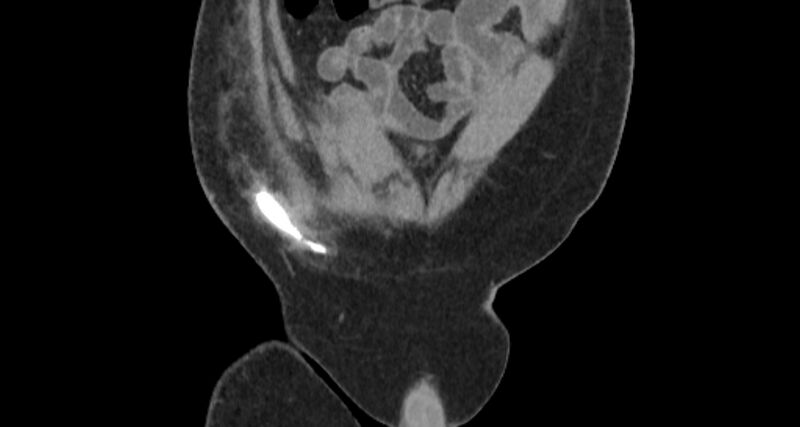 File:Colocutaneous fistula (Radiopaedia 56401-63062 C 13).jpg
