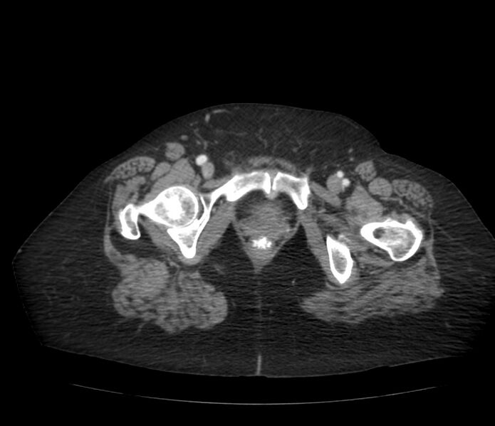 File:Colonic diverticulosis (Radiopaedia 22934-22957 A 75).jpg
