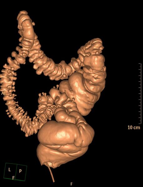 File:Colonic diverticulosis (Radiopaedia 29641-30159 3D VC 14).jpg