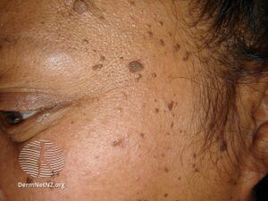 Dermatosis papulosa nigra (DermNet NZ lesions-dpn1).jpg