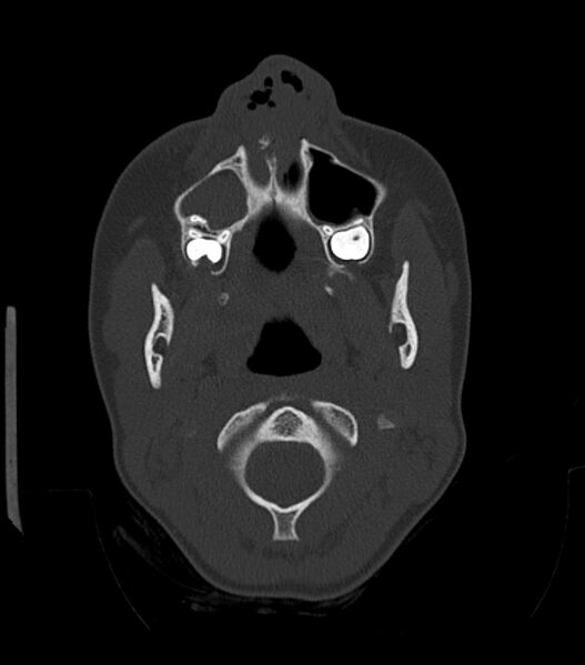 File:Nasoorbitoethmoid fracture (Radiopaedia 90044-107205 Axial bone window 52).jpg